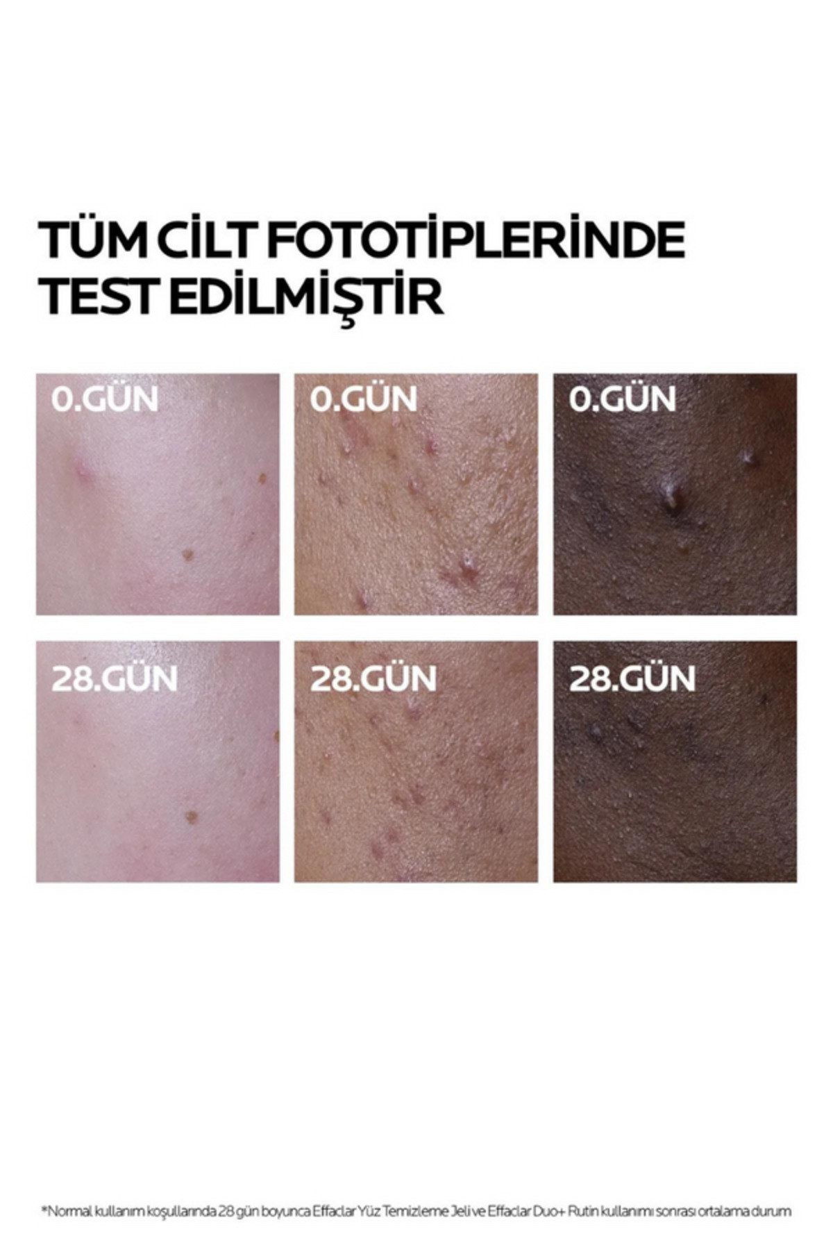 Effaclar Duo+M Yağlı, Akne/Sivilce Eğilimli Ciltler için Yüz Bakım Kremi 15ml
